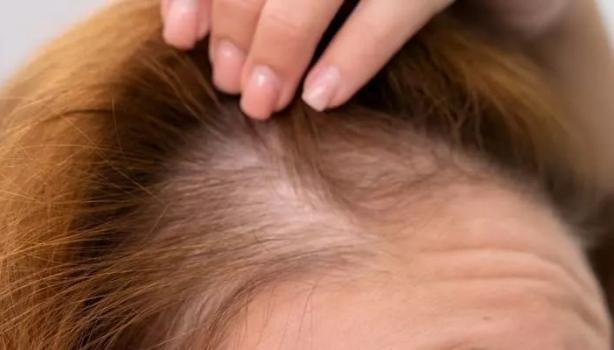 O que é alopecia e quais alimentos devem ser aliados