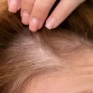 O que é alopecia e quais alimentos devem ser aliados
