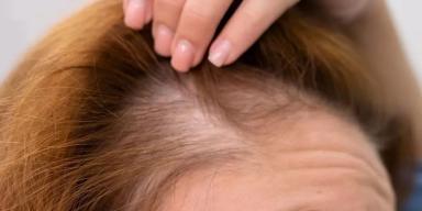 O que é alopecia e quais alimentos devem ser aliados
